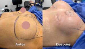 Implantes Senos