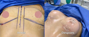 Implantes Senos